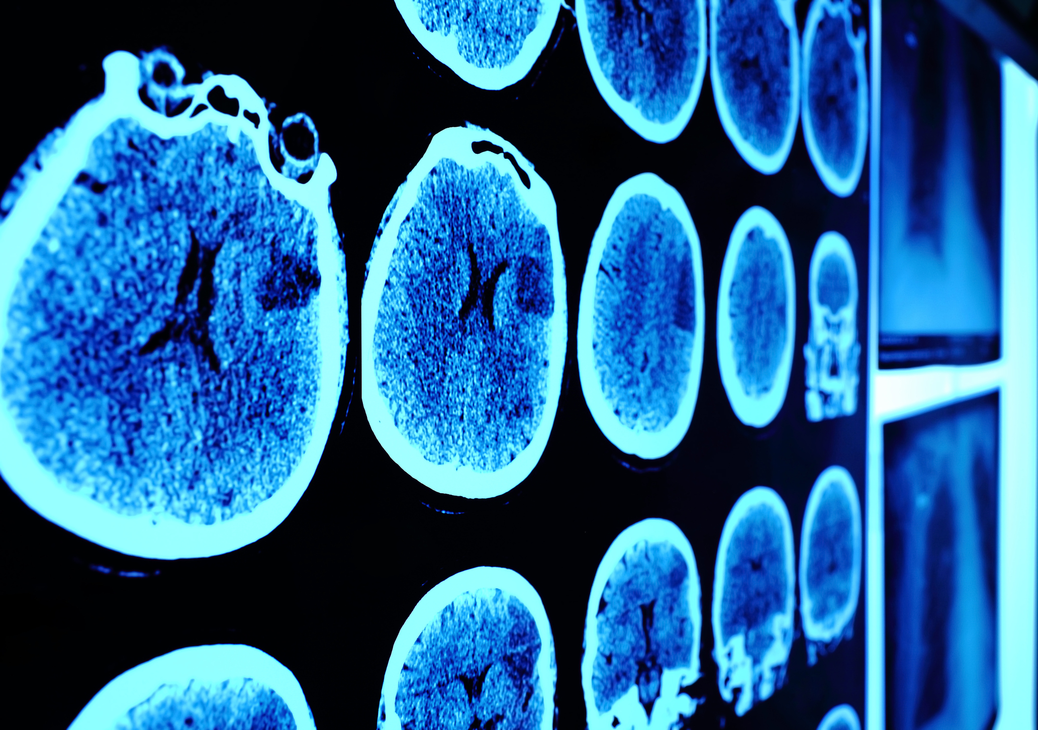 Understanding the Genomic Complexities of Glioblastoma Tumors