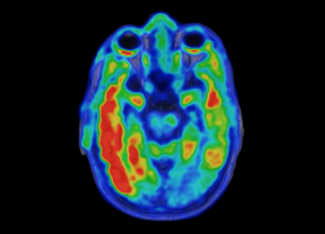 Biomarker Predicts Cognitive Decline in Alzheimer’s Disease