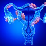 Study Identifies Racial Differences in Rare Endometrial Cancer