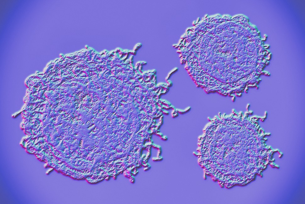 Outsmarting Chemo-Resistant Ovarian Cancer